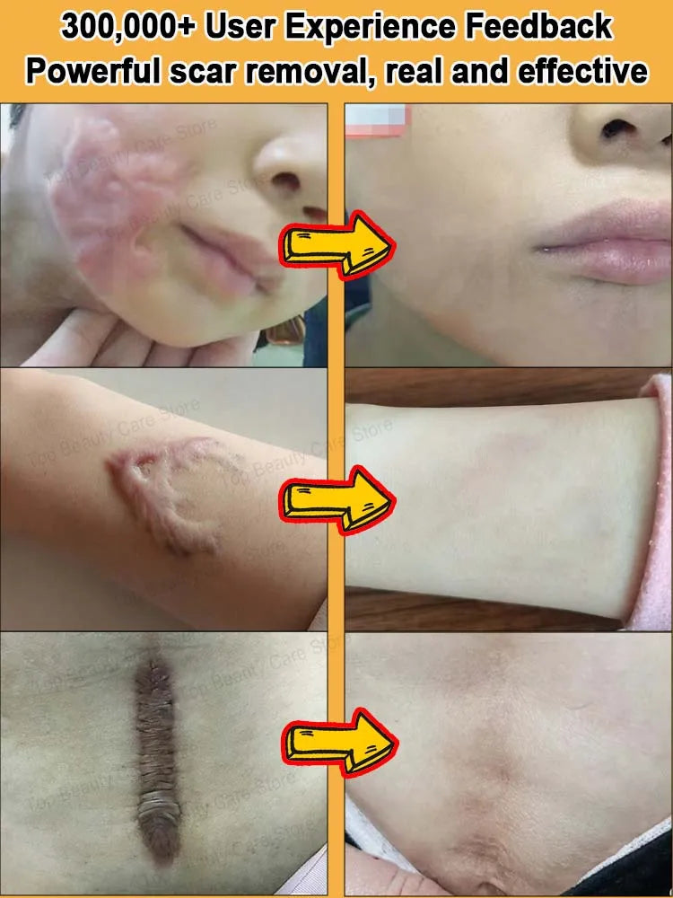 Wound scar laser products