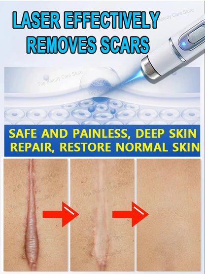 Wound scar laser products